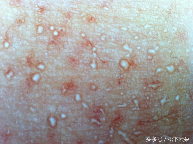 用西瓜皮怎么治痱子,西瓜皮治痱子方法