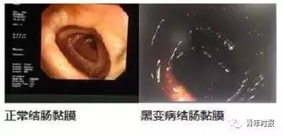 年轻女孩查出肠癌晚期医生惋惜,高中女孩患巨结肠