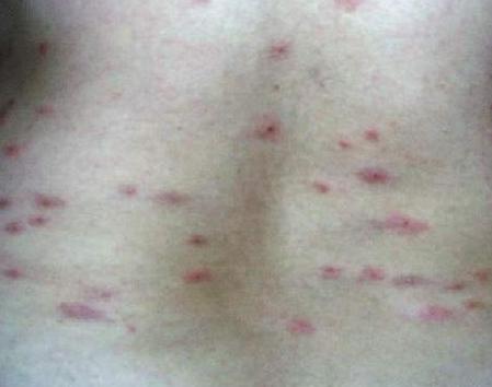 过敏性荨麻疹是什么原因引起的,麻疹到底是怎么回事