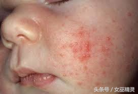 宝宝脸上长像扁平疣的疙瘩,宝宝脸上长小颗粒是丝状疣吗