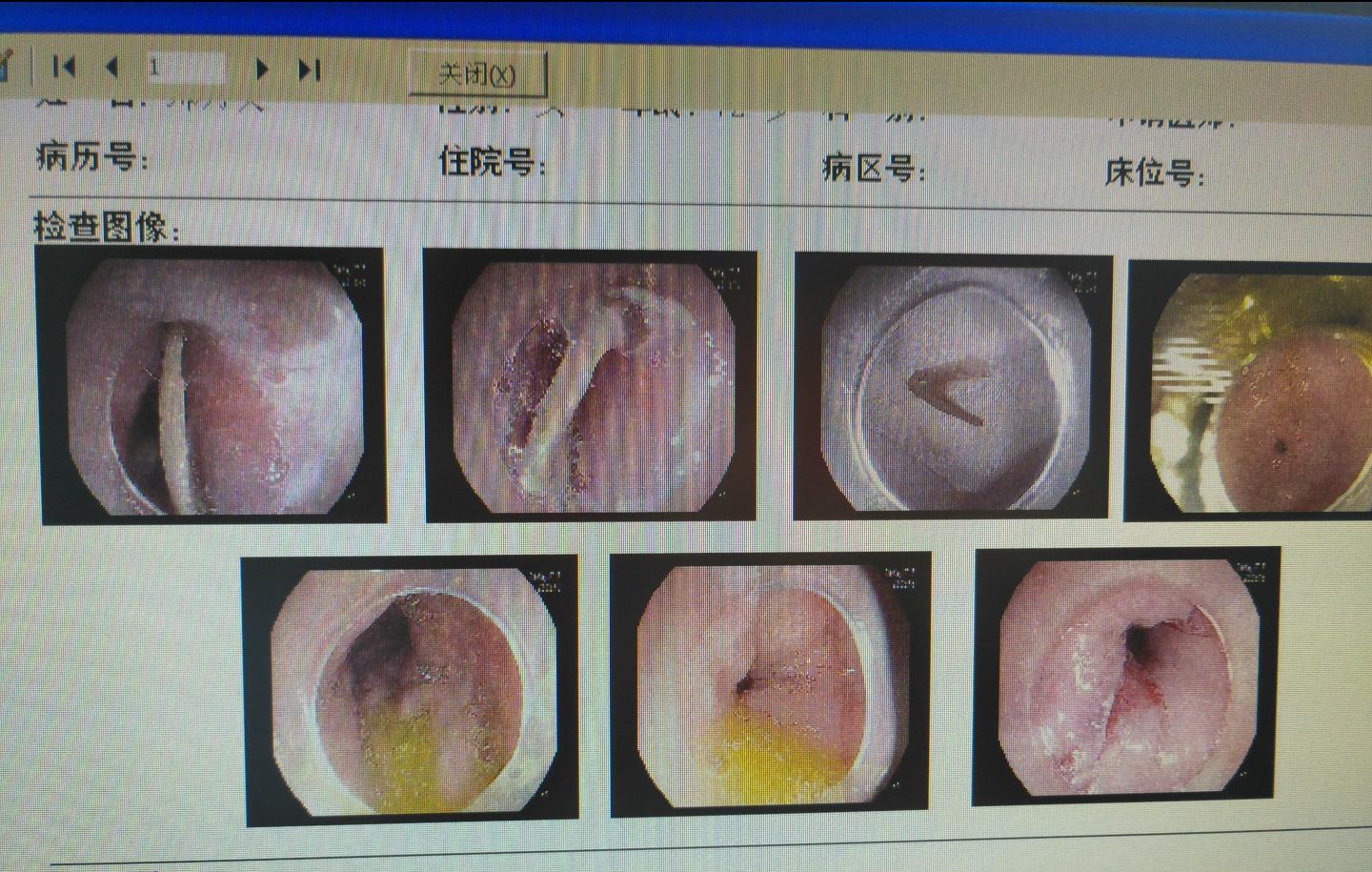 被鱼骨头卡住喉咙最有效方法,骨头卡住食道有什么表现