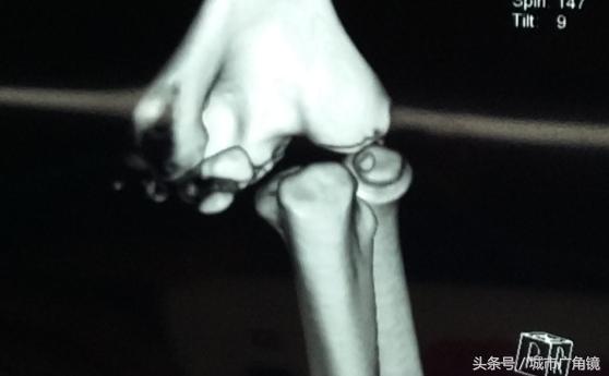 儿童骨折骨头长歪了会自行矫正吗,小孩膝关节骨折后可以恢复正常吗