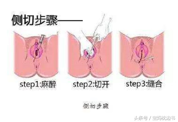 为什么医生不建议剖腹产顺产,宁可剖腹产也不用产钳