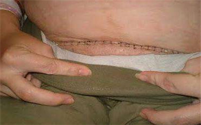 让过来人告诉你剖腹产到底啥滋味,谁说无痛分娩不会腰疼