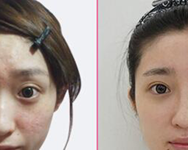 挤完痘痘后怎样防止发炎,挤完痘痘之后怎么处理防止痘坑