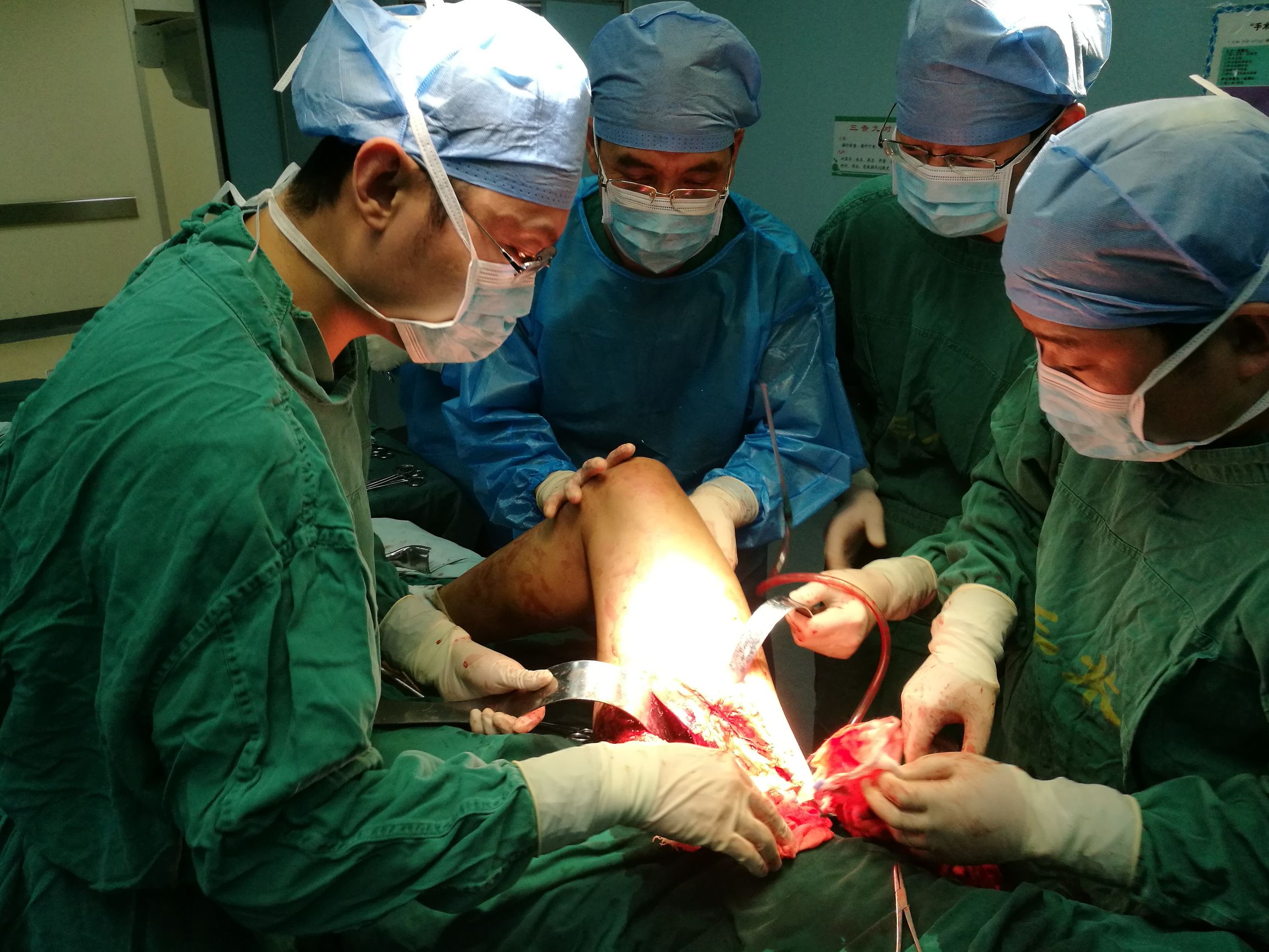 大医精诚，多科强强联手成功救治一例股总动静脉完全断裂患者