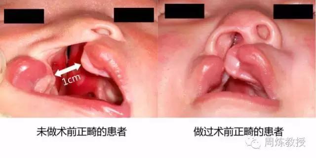 什么原因导致唇腭裂宝宝,唇腭裂的妈妈生孩子要注意什么
