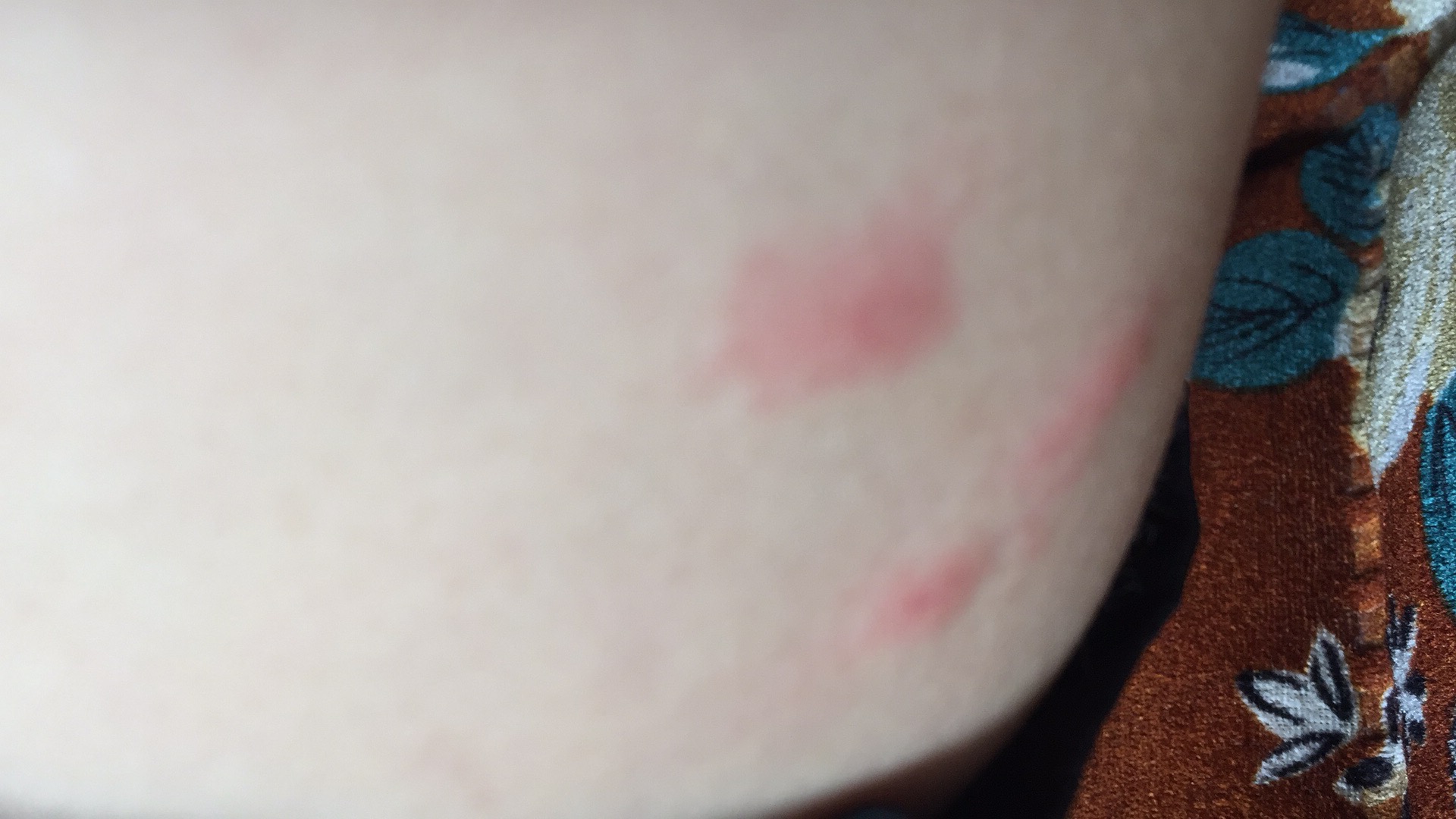 过敏性荨麻疹是什么原因引起的,麻疹到底是怎么回事