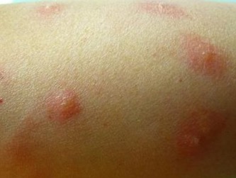 过敏性荨麻疹是什么原因引起的,麻疹到底是怎么回事