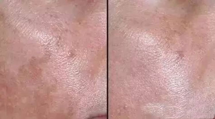 女人长斑肤质差教你一招轻松淡斑,刘艳青美白淡斑