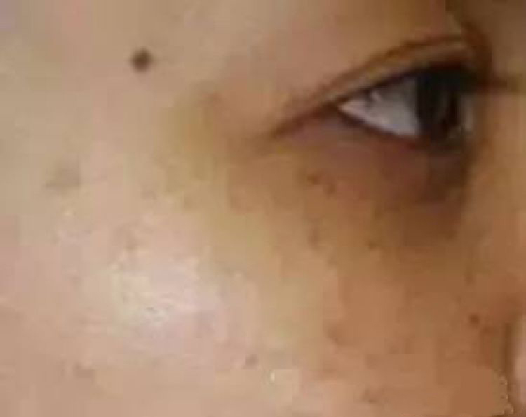 女人长斑肤质差教你一招轻松淡斑,刘艳青美白淡斑