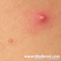 宝宝脸上长像扁平疣的疙瘩,宝宝脸上长小颗粒是丝状疣吗