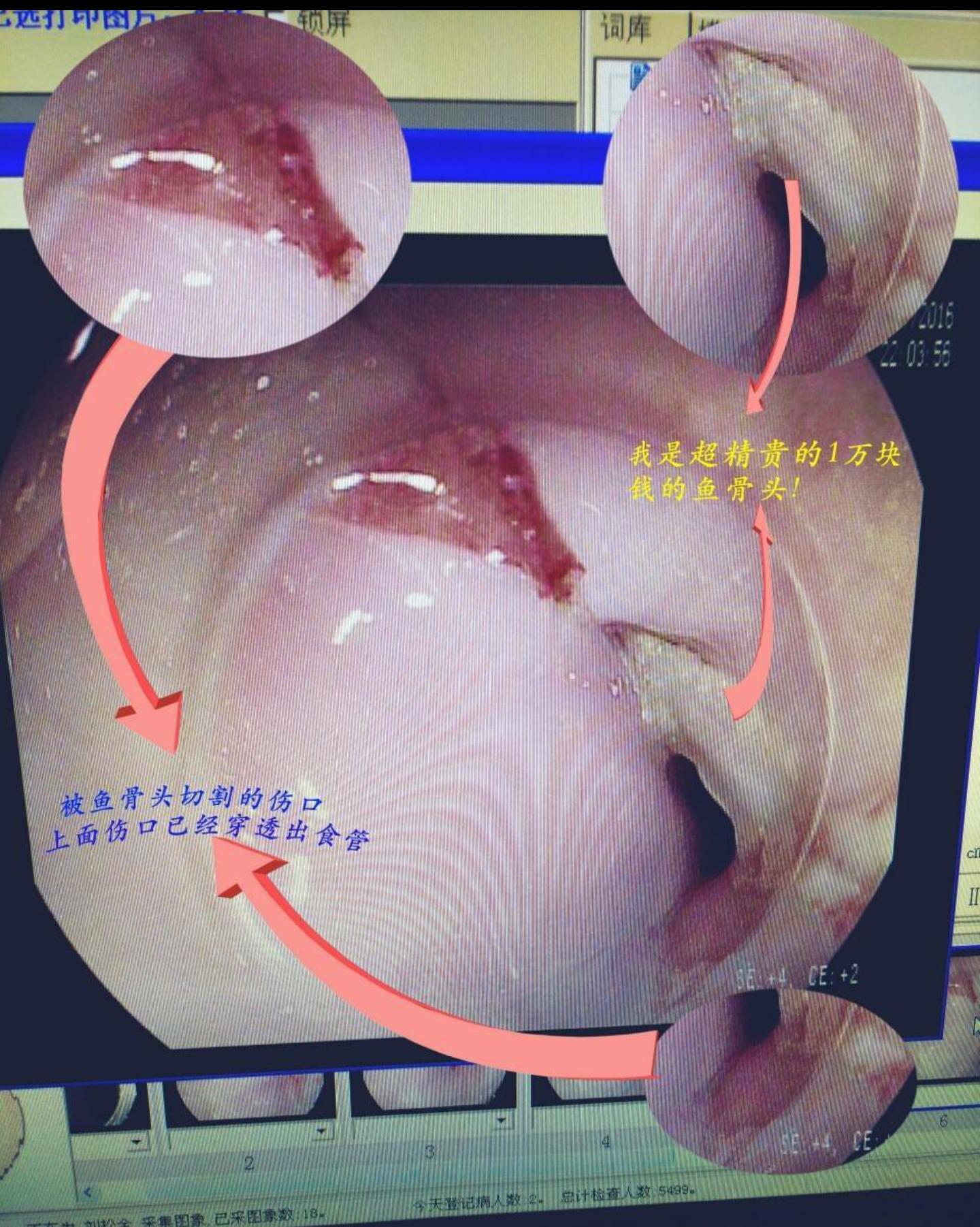 被鱼骨头卡住喉咙最有效方法,骨头卡住食道有什么表现