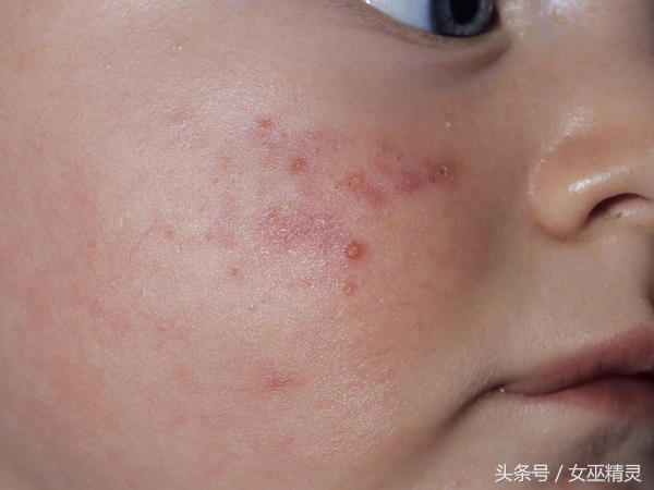 宝宝脸上长像扁平疣的疙瘩,宝宝脸上长小颗粒是丝状疣吗