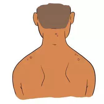 长痘痘的原因你知道有多少,长痘痘的原因你了解多少