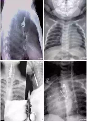 端午节吃粽子被噎死,端午假期西安1医院9例枣核卡食道