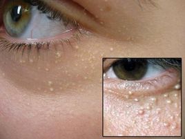 正确认识脂肪粒，做一美女子