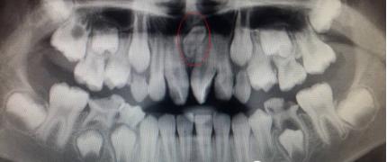 孩子多长了颗牙怎么办？—306医院6.1科普（5）
