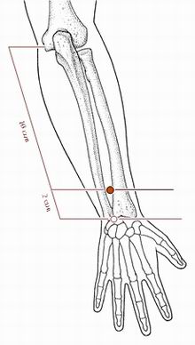 神经根型颈椎病的针灸理疗治疗,针灸治疗颈椎病能不能去根