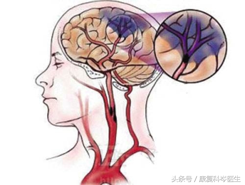 补充叶酸能预防中风是真的吗,叶酸怎么服用可降低中风风险