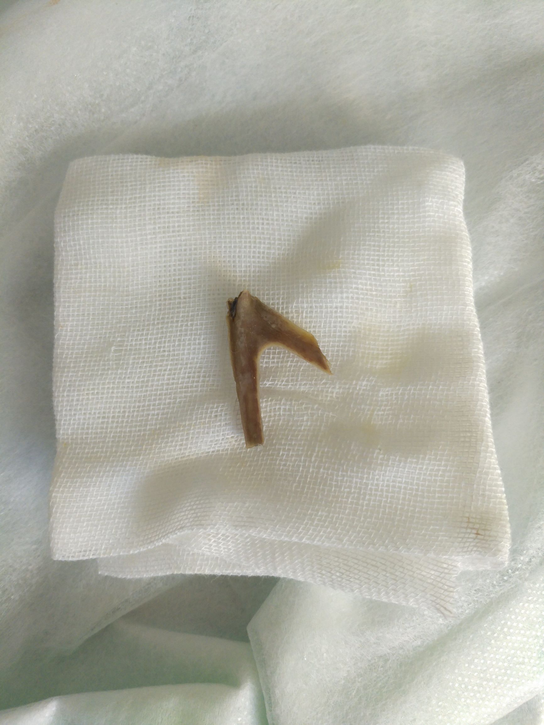 被鱼骨头卡住喉咙最有效方法,骨头卡住食道有什么表现