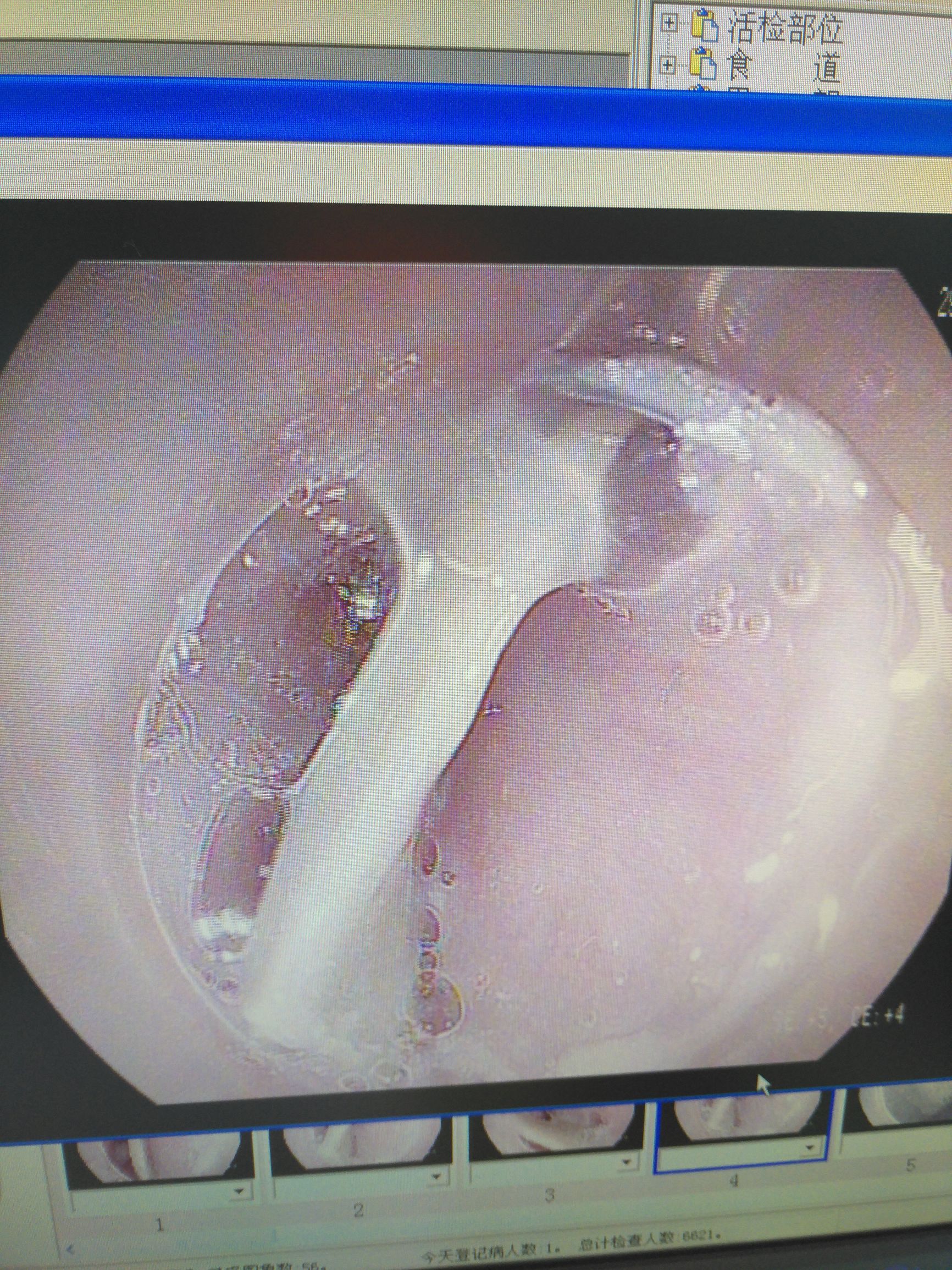 被鱼骨头卡住喉咙最有效方法,骨头卡住食道有什么表现