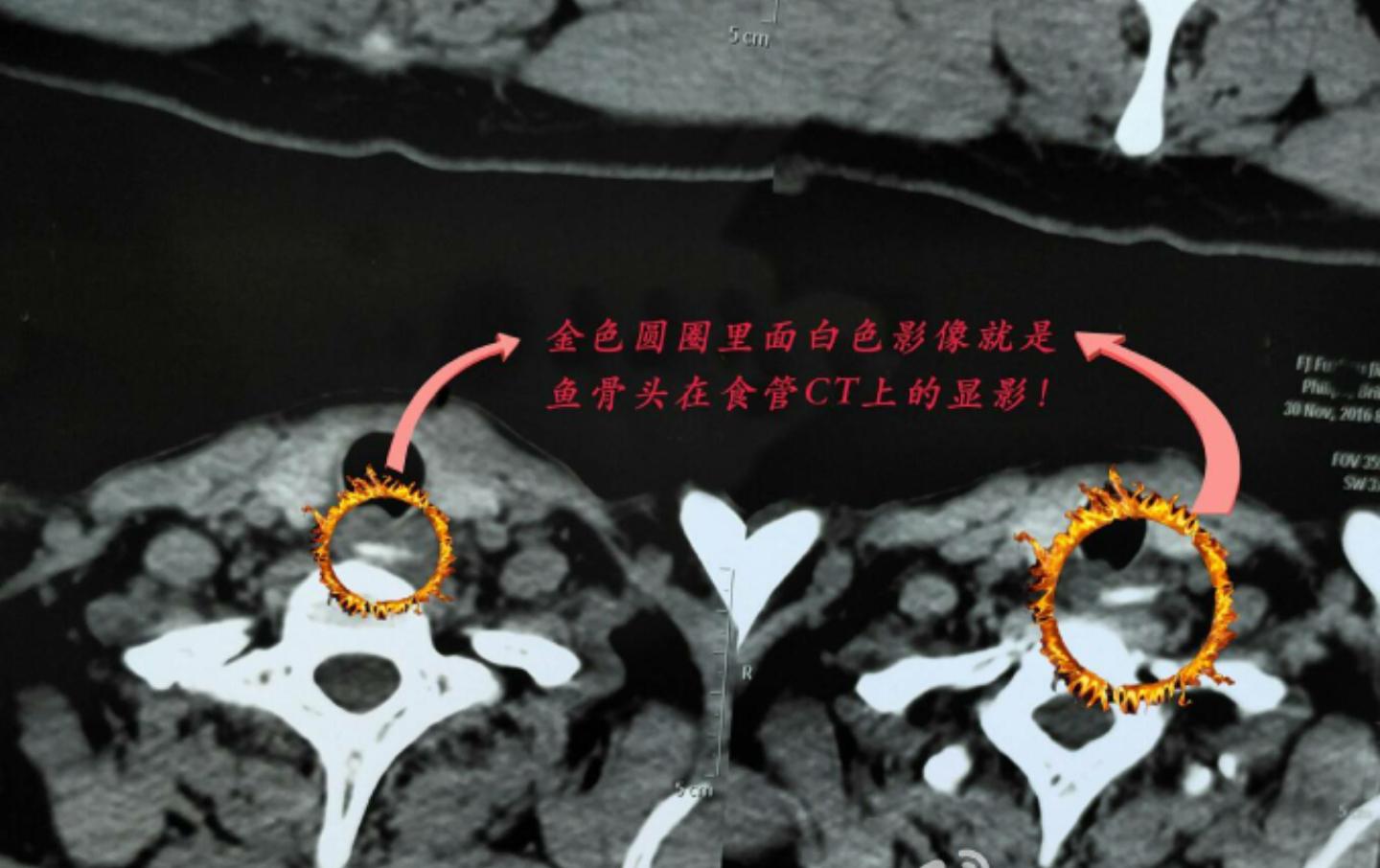 被鱼骨头卡住喉咙最有效方法,骨头卡住食道有什么表现