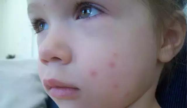 宝宝被蚊子咬到又红又肿,宝宝被蚊子咬后抓破皮能擦什么药