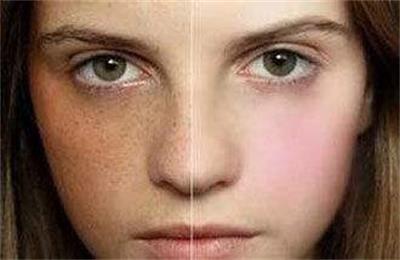 激光去斑哪种斑最好去,药水点斑和激光点斑哪个好