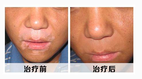 老生姜与白癜风,生姜能治白癜风