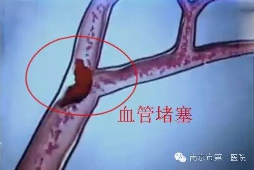 腿中风能治好吗,腿中风后遗症怎么样的