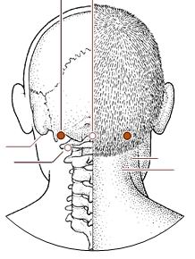 神经根型颈椎病的针灸理疗治疗,针灸治疗颈椎病能不能去根