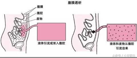 肾病选择腹透还是血透,血透和腹透哪个质量高