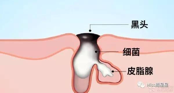 涓嶈姳閽辫繕鏈夋晥鐨勫幓榛戝ご鏂规硶get,娓╁拰楂樻晥鍘婚粦澶寸殑鏂规硶