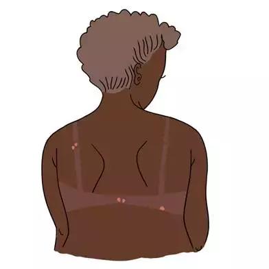 长痘痘的原因你知道有多少,长痘痘的原因你了解多少