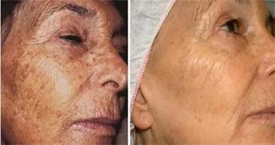 有老年斑有没有办法去除老年斑,老年斑的预防和治疗根除老年斑