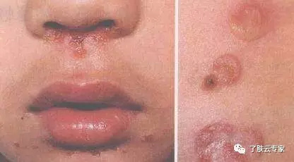 儿童皮肤病防治知识大全,儿童皮肤科护理流程