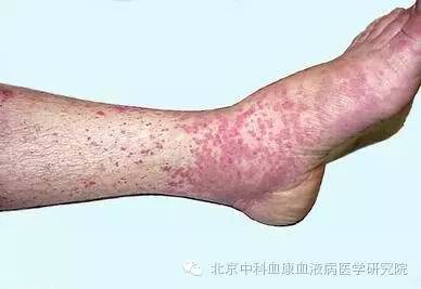 过敏性紫癜是否很难真正的痊愈,过敏性紫癜怎么久治不愈