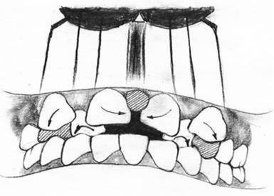 孩子多长了颗牙怎么办？—306医院6.1科普（5）