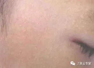 儿童皮肤病防治知识大全,儿童皮肤科护理流程