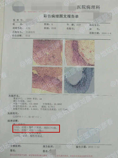 病例分享——宫颈CIN1级的治疗