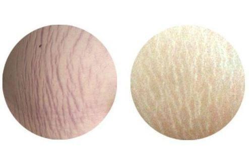 肥胖纹是不能消除的，只能淡化，跟着这5个方法在家也能改善