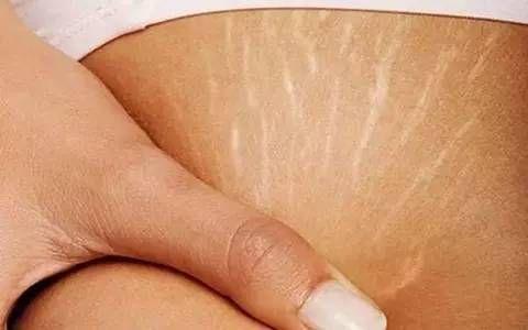 肥胖纹是不能消除的，只能淡化，跟着这5个方法在家也能改善
