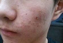 台州消除青春痘疤痕,男士青春痘疤痕怎么修复