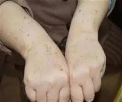 有老年斑有没有办法去除老年斑,老年斑的预防和治疗根除老年斑