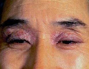 神经性皮炎治好后皮肤能恢复吗,神经性皮炎用冷冻疗法是否能治好