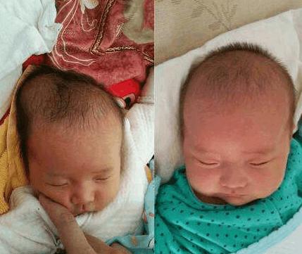 新生儿头上突然起个软包照片,新生儿头发现一个包