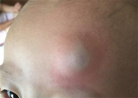 宝宝额头摔个大包一直存在,宝宝额头摔个大包扩散了怎么办