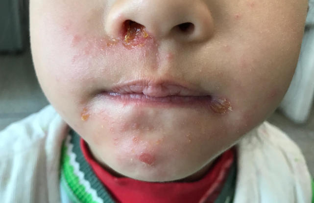 原来黄水疮有传染性，如何正确治疗呢？