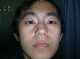 华夏讲述:白斑反复有原因?早早防范不复发?